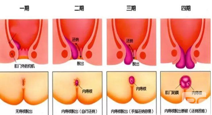 运城众泰肛肠医院：内痔不痛也需要治疗吗？