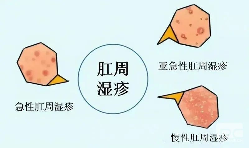 运城众泰肛肠医院：肛门瘙痒，这是一件非常尴尬的事......