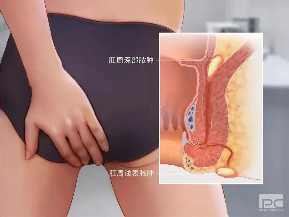 运城众泰肛肠医院：肛周脓肿是火疖子吗？