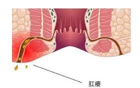 运城众泰肛肠医院：肛瘘术后如何处理