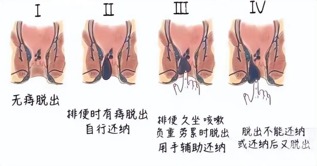 运城众泰肛肠医院：偷偷摸摸的长了个内疮，它长什么样子