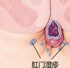 运城众泰肛肠医院：内痔放任不管可诱发多种疾病