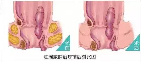 运城众泰肛肠医院：被细菌“侵犯”的肛周脓肿能自愈吗？