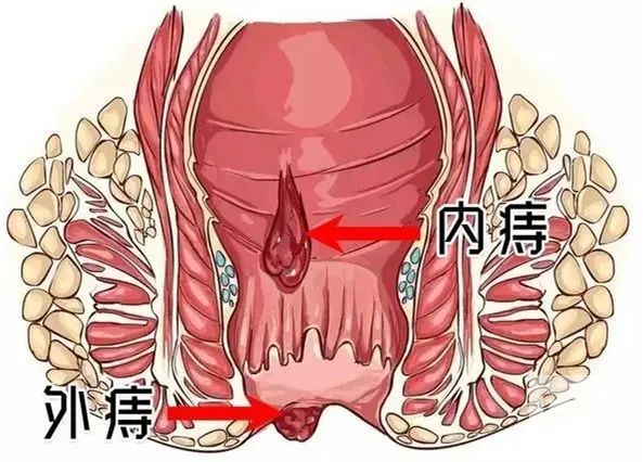 运城众泰肛肠医院：患有外痔怎么办？