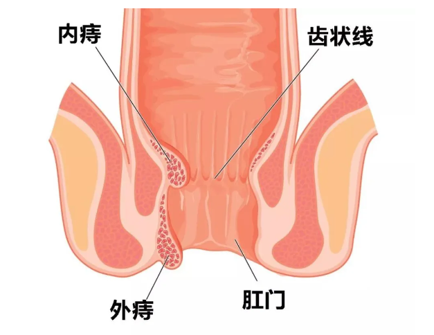 运城众泰肛肠医院：肛门肿物疼是不是代表病情严重了？