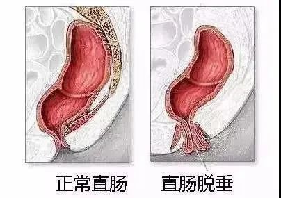 运城众泰肛肠医院：了解一下哪些疾病可能会引起肛门异物