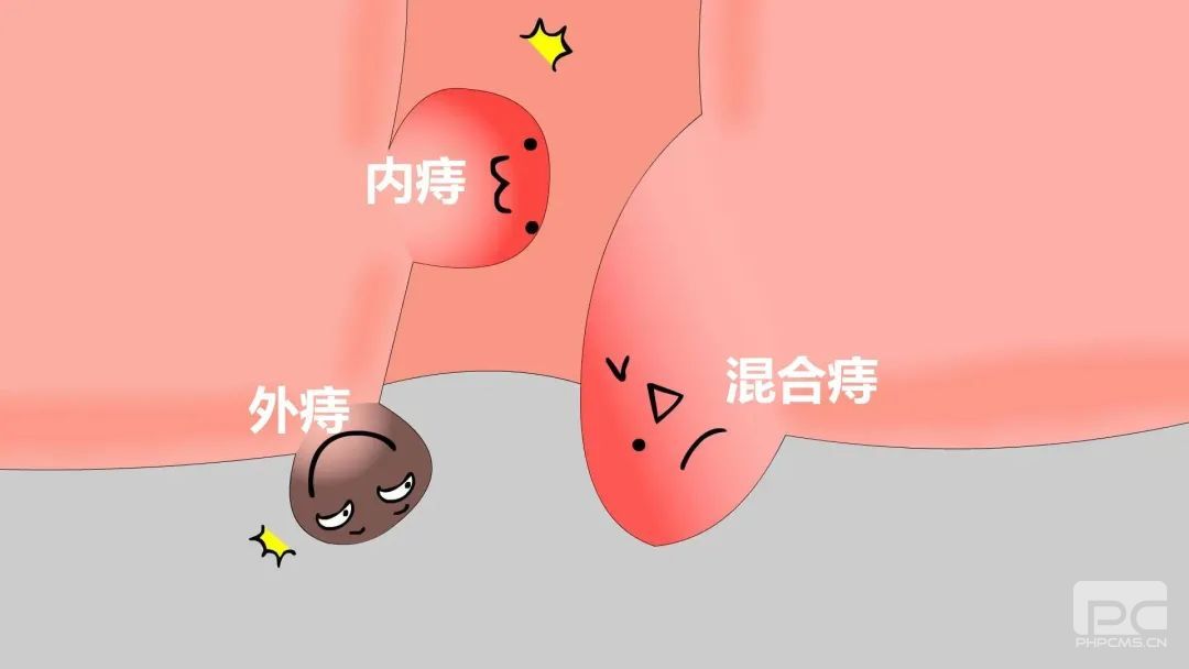 运城众泰肛肠医院:女性外痔疮是长什么样?