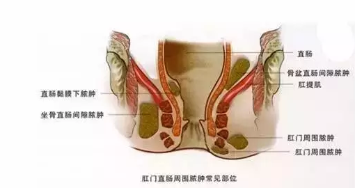 运城众泰肛肠医院:肛周脓肿远比你想像的更可怕