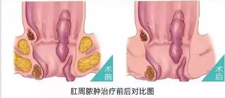 运城众泰肛肠医院:肛周脓肿远比你想像的更可怕