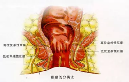 运城众泰肛肠医院：小小肛瘘危害大！