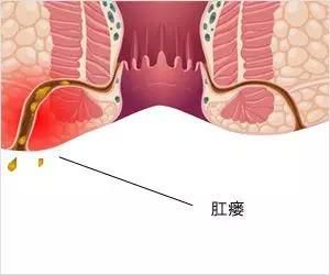 运城众泰肛肠医院:肛门瘙痒,只是不卫生?这5大疾病,同样是祸根!