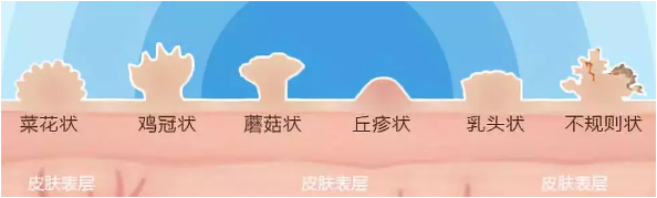 运城肛肠医院:肛门瘙痒?警惕肛门尖锐湿疣~~