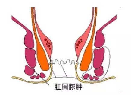 运城肛肠医院:肛肠疾病中的3大“急”病,你知道吗?