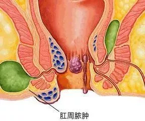 运城众泰肛肠医院:肛周脓肿为什么更“青睐”男性?