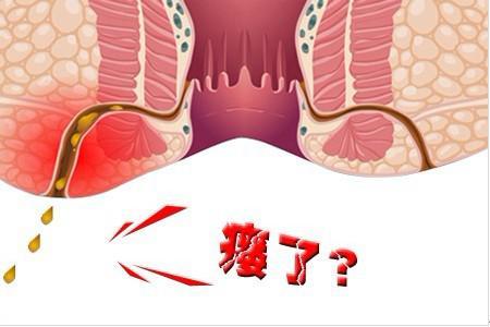 运城众泰肛肠医院:女性患上肛瘘要怎么办呢?