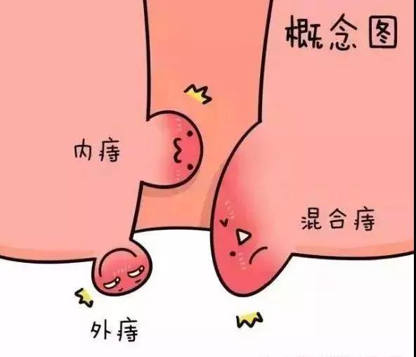 运城众泰肛肠医院：什么是血栓性外痔
