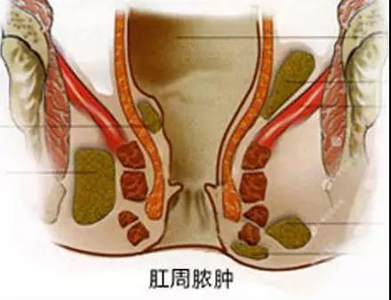 运城众泰肛肠医院：寒冬，注意肛周脓肿伤人猝不及防