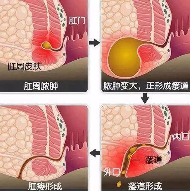 运城众泰肛肠医院：屁大点事?不,肛瘘必须治!