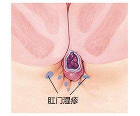 运城众泰肛肠医院：老年肛门湿疹如何预防保健