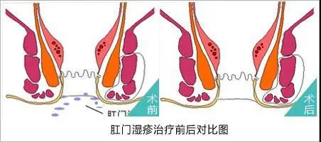 运城众泰肛肠医院：肛门湿疹有哪些危害？