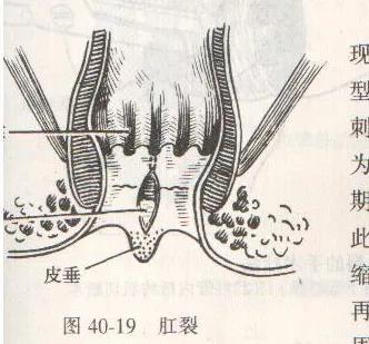 运城众泰肛肠医院：肛裂了啥感觉？啥样的肛裂需要手术？