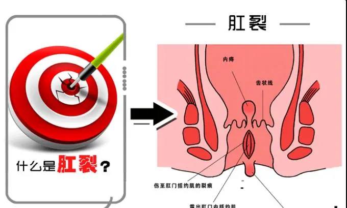运城众泰肛肠医院：屁股撕裂般疼痛是怎么了？
