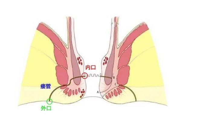 运城众泰肛肠医院：肛瘘找上门？看看自己犯了什么错