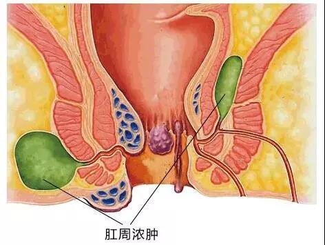 运城众泰肛肠医院：想让屁股少遭罪，肛周脓肿你必须了解！