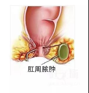 运城众泰肛肠医院：宝宝得了肛周脓肿怎么办？