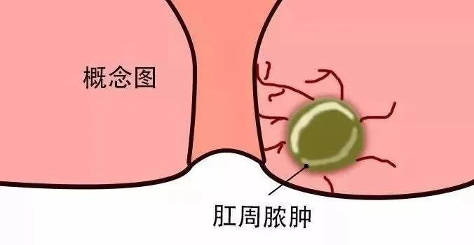 运城众泰肛肠医院：患了肛周脓肿可别盲目消炎保守治疗，那样只会加重病情！