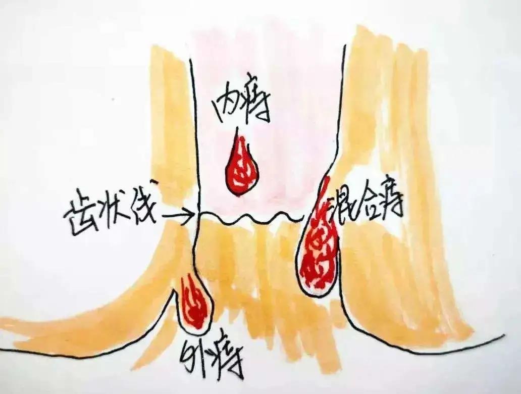 运城众泰肛肠医院：女性混合痔有哪些危害？