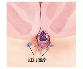 运城众泰肛肠医院：肛门湿疹的危害及预防！