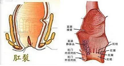 运城众泰肛肠医院：肛裂是怎么造成的？
