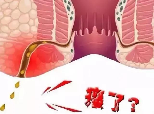 运城众泰肛肠医院：不想屁屁遭罪，“肛周脓肿”了解一下！