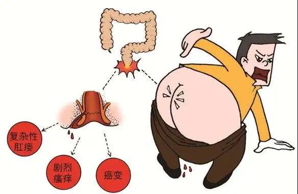 运城众泰肛肠医院：“痔疮”听得多，“肛瘘”你了解过吗？