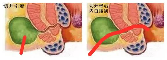 运城众泰肛肠医院：肛周脓肿的真情自白！