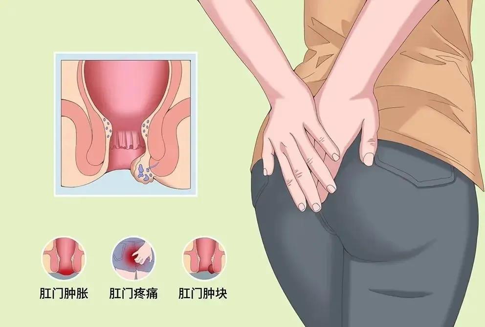 运城众泰肛肠医院：季肛肠疾病高发，教你几招远离痔疮！