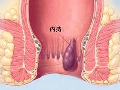 运城众泰肛肠医院：内痔出血严重吗？1分钟自测你的痔疮属于几期