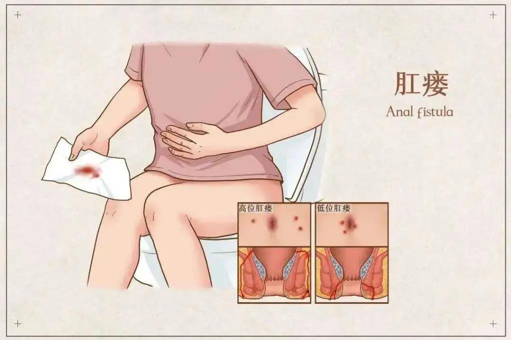运城众泰肛肠医院：肛瘘咋回事？可不能不顾？