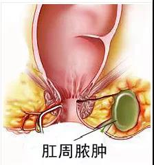运城众泰肛肠医院：屁股上的肿包不是“上火”！它可比“上火”危险多了！
