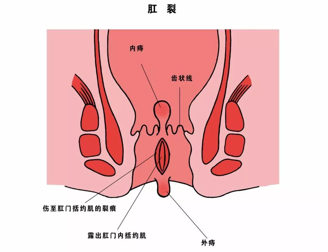 运城众泰肛肠医院：肛裂反复发作找“存在感”怎么办？