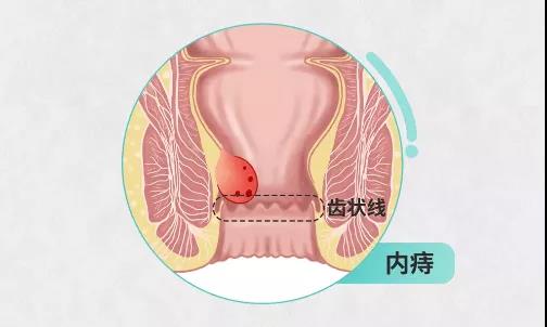 运城众泰肛肠医院：内痔有脱出的时候该注意什么？