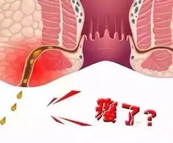 运城众泰肛肠医院：肛瘘怎么形成的？只有手术才能治疗吗？