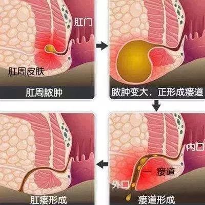 运城众泰肛肠医院：肛瘘就是肛门附近有个小洞吗？