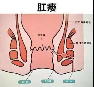 运城众泰肛肠医院：肛瘘必须手术吗？