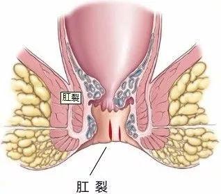 运城众泰肛肠医院：肛裂该如何缓解痛苦？这些方法来帮你！