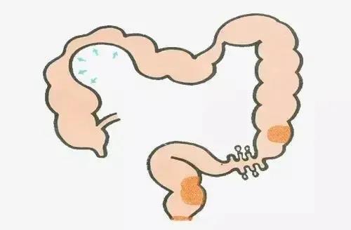 运城众泰肛肠医院：排便不尽，出口梗阻型便秘怎么回事？