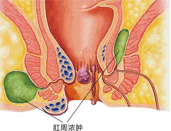 运城众泰肛肠医院：肛周脓肿来临前的“信号”有哪些？