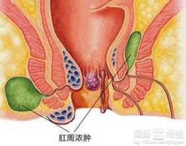 运城众泰肛肠医院：我的肛门清洗很干净，为什么会感染细菌发生肛周脓肿？