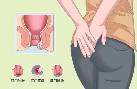 运城众泰肛肠医院：关于肛瘘手术，必须明确7个关键问题